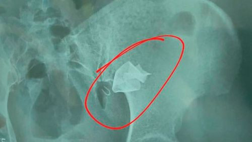 Detención domiciliaria en horario nocturno para el médico que olvidó gasa en el vientre de una mujer