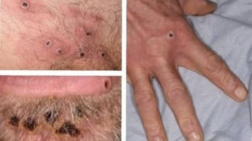La OMS confirmó más de 1.000 casos de viruela del mono y tres nuevas muertes en el último mes