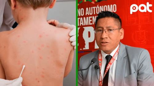 Tercer caso de sarampión confirmado en La Paz